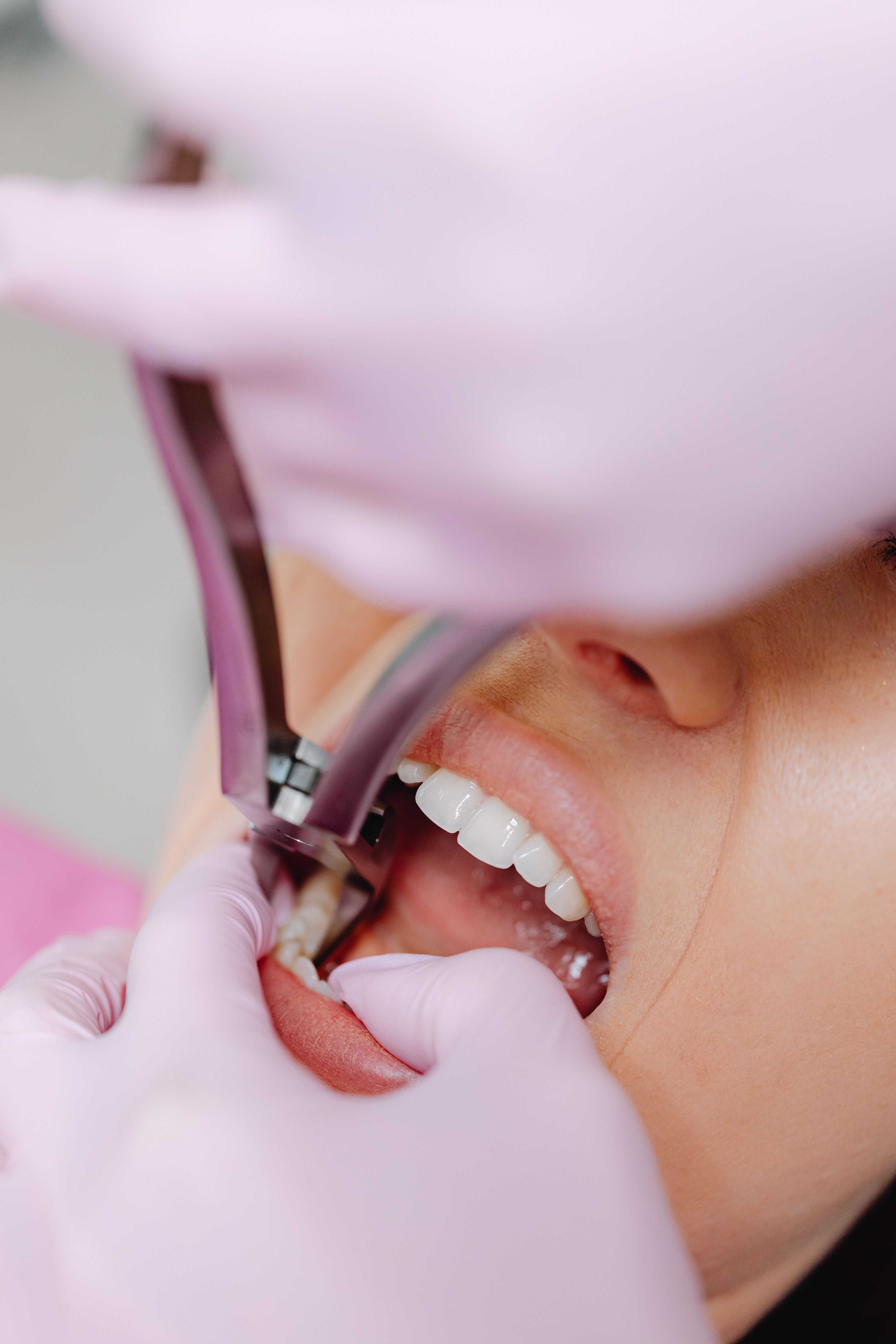 Extracciones dentales simples y complejas